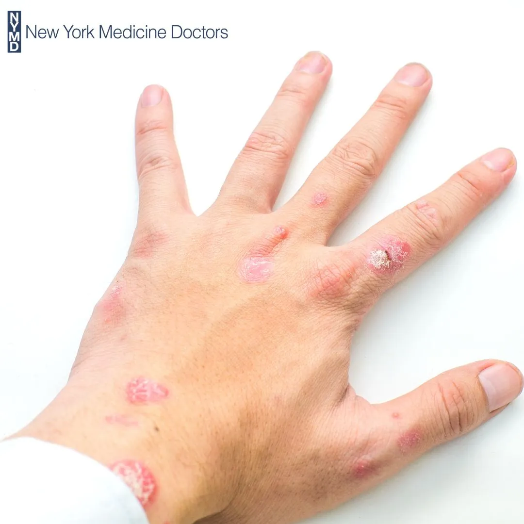The Impact of Psoriasis on Daily Life